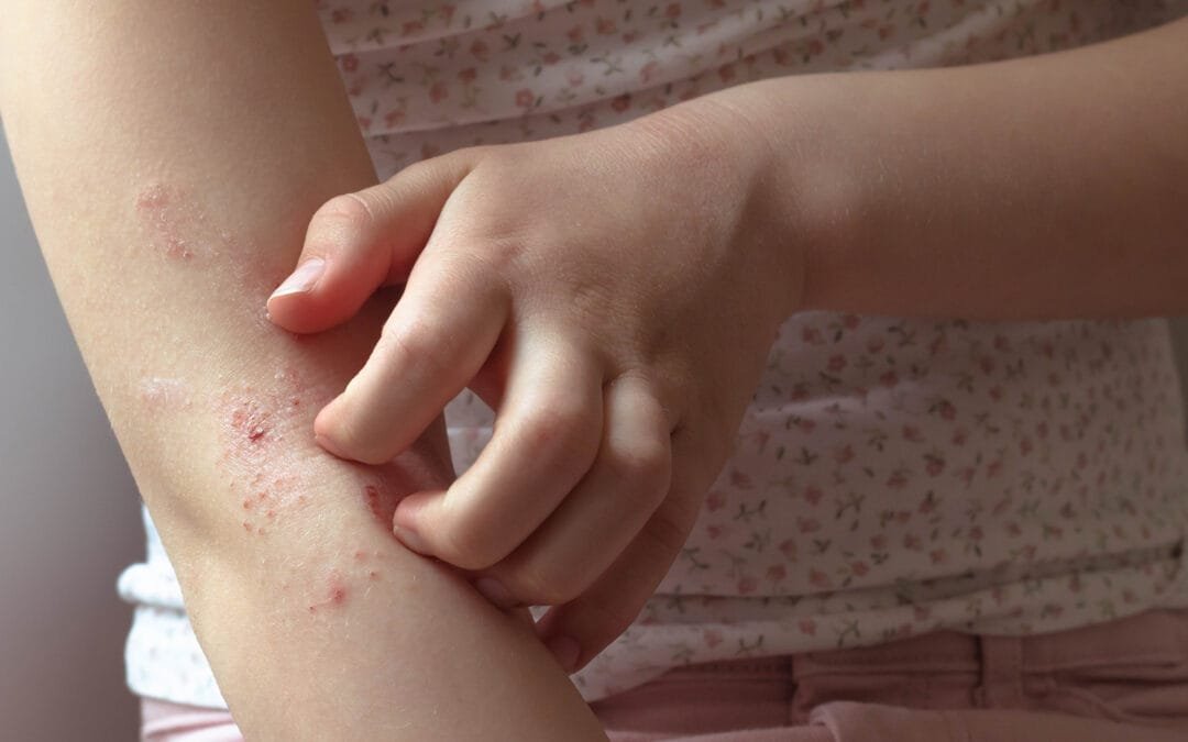 eczema skin rash
