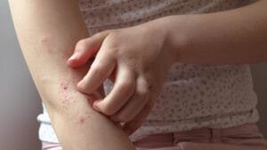eczema skin rash